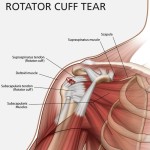 Rotator Cuff Injury: Physical Therapy and Surgery